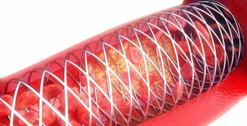 裸金属支架与药物洗脱支架/裸金属支架与药物洗脱支架区别-第3张图片