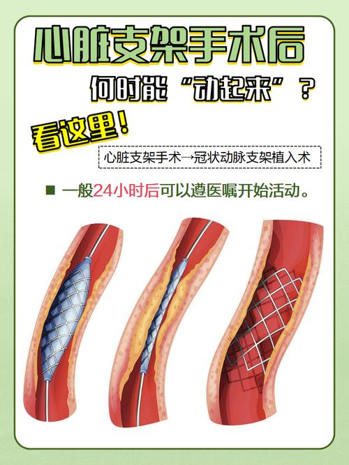 裸金属支架与药物洗脱支架/裸金属支架与药物洗脱支架区别-第6张图片