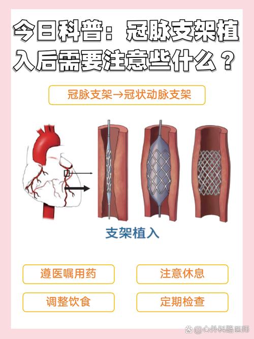 关于“什么叫裸金属支架”你可能想知道-第8张图片