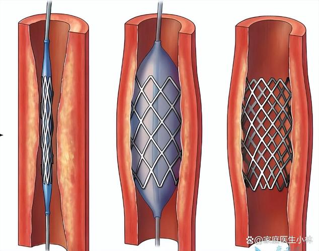 关于“什么叫裸金属支架”你可能想知道-第9张图片